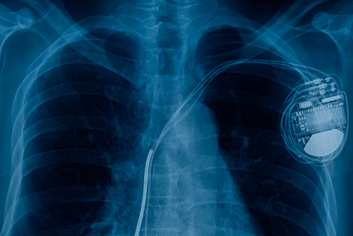 X-ray of a chest, which shows a pacemaker on the right-hand right of the chest cavity. 